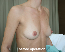 plastic-surgery-breast-augmentation